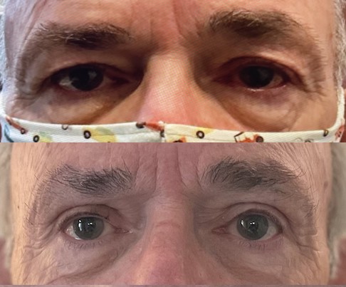 men-male-blepharoplasty-phoenix-az-arizona-ophthalmologist-plastic-surgery-eyelid-lift